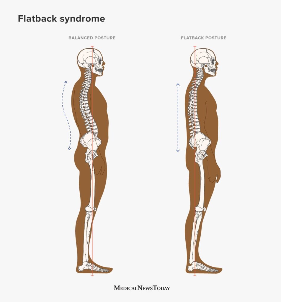 A person performs a chest-opening stretch to improve a straight back.